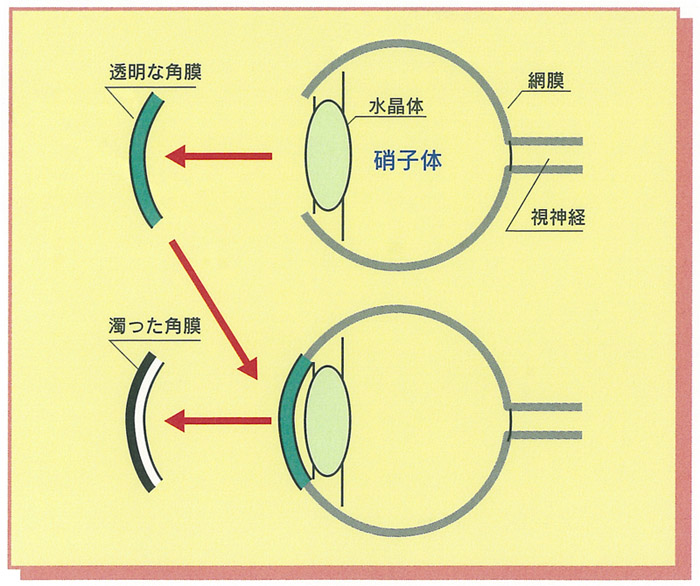 角膜移植